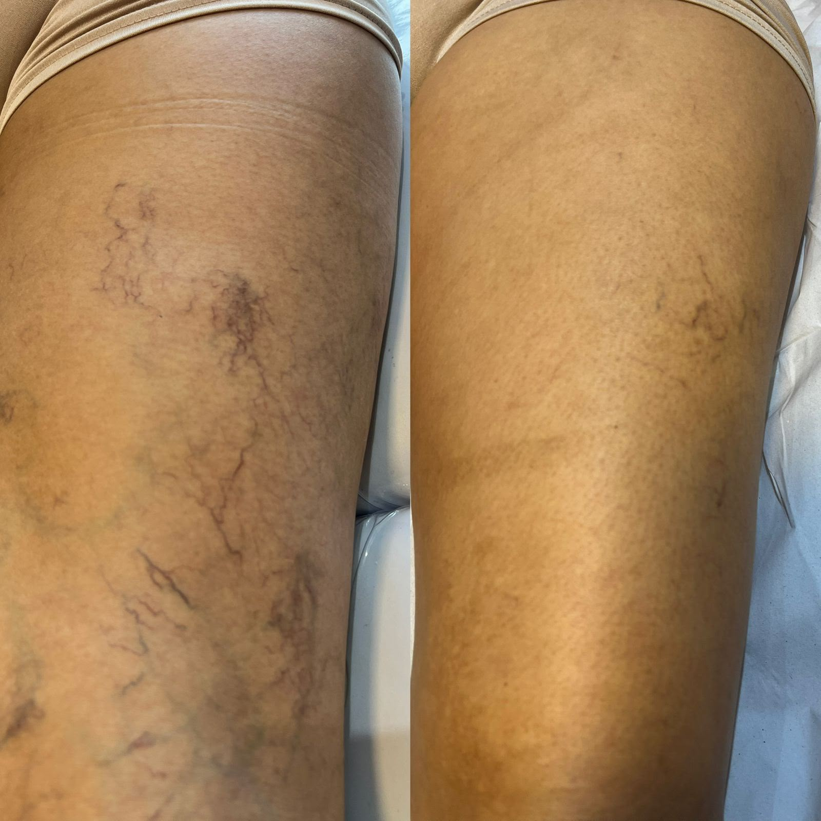 Antes e depois de secagem de vasinhos nas pernas