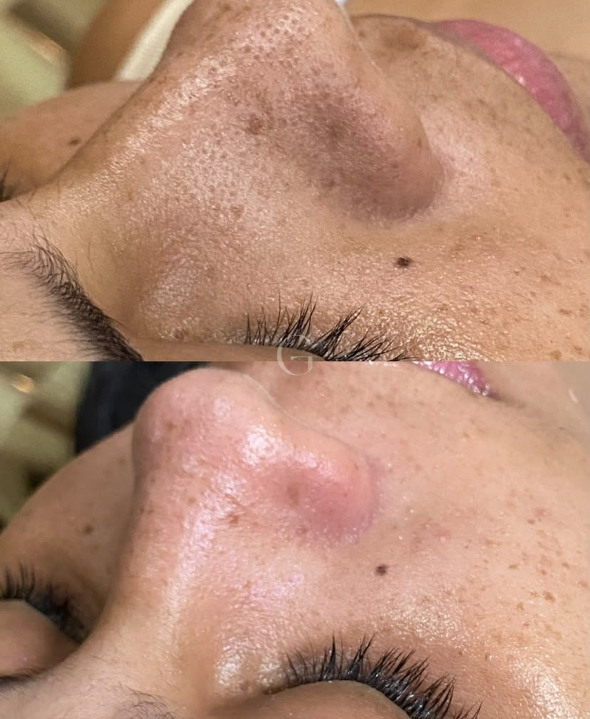 Antes e depois de tratamento de pele na região do nariz