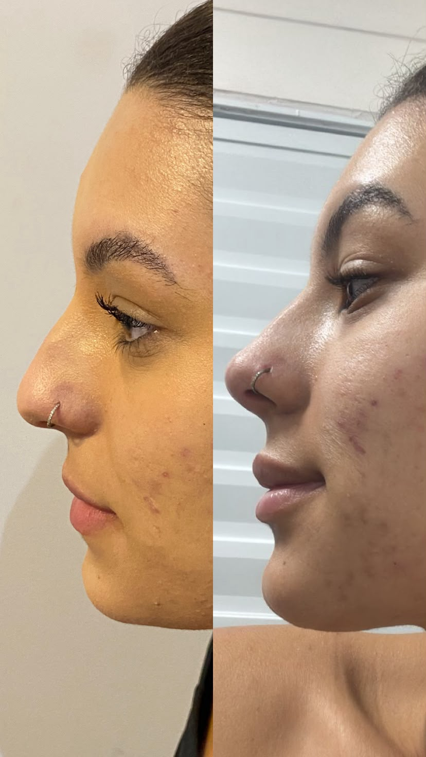 Antes e depois de rinomodelação