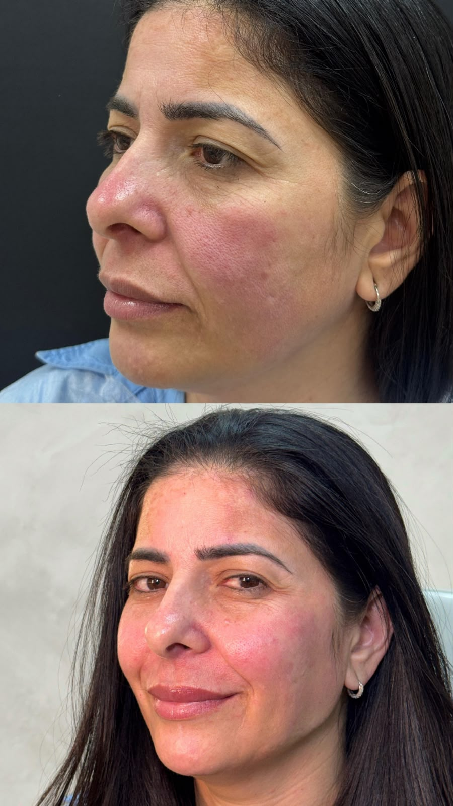 Antes e depois de tratamento para vermelhidão facial