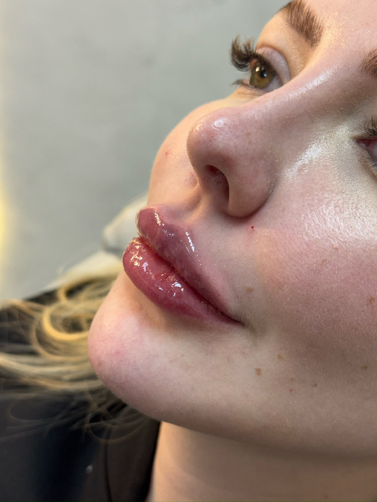 Detalhe de lábios após preenchimento labial